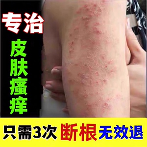 皮肤瘙痒止痒抑菌全身痒外用湿疹去根手臂小腿过敏癣药膏紫花地丁