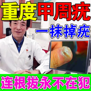 甲周疣专用药去除儿童成人手指肉刺足跖疣祛疣瘊子扁平疣立净药膏