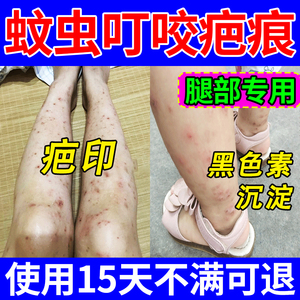 腿上去疤印去黑色素沉淀蚊子蚊虫叮咬祛疤膏膝盖儿童膏除疤痕JY