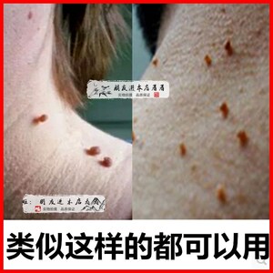 克忧液克尤液疣瘊净疣体去除必治手脚脸上克尤王净鸡尤清皮赘克液