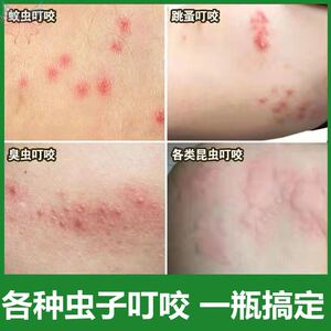 被跳蚤咬臭虫咬治蚊虫叮咬止痒螨虫咬擦蚊子咬红肿消印的药软膏