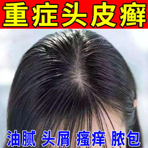 头癣药膏银屑癣治顽固性皮癣皮痒头皮癣藓毛囊炎头部专用真菌感染