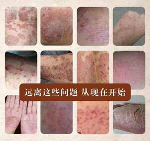藏药廯毒王廯湿药膏创新足廯菌克星甲廯牛披皮癣金今廯王