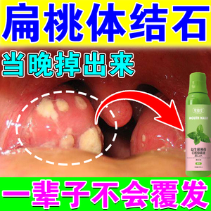 扁桃体结石漱口水结石祛除工具除口臭清理口腔神器咽喉肿痛异物感