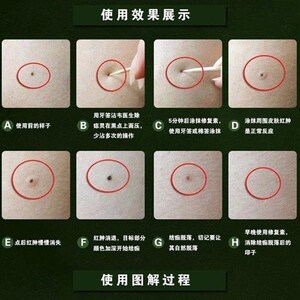韦痦子除志灵去志药水取c痣膏雀医生取黑痣点斑水