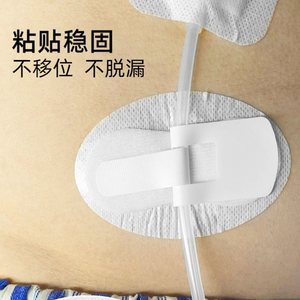 尿管固定装置腹透体表导管膀胱造瘘管胆管胆汁引流管固定贴通用型