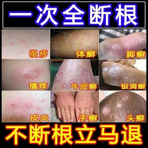 治疗顽固廯银屑病止痒抑菌皮肤瘙痒湿疹去根手足癣外用祛癣中药膏