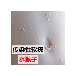 传染性软疣儿童病毒性软疣膏去镊子刮勺药膏去除工具宝宝水猴子药