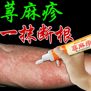 荨寻麻疹过敏止痒断根专用药膏治疗急慢性风团皮肤瘙痒克星外用药