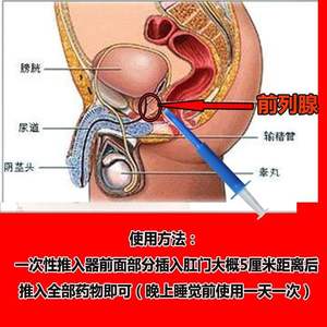 男性前列腺炎位置图片图片