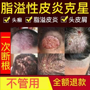 脂溢性皮炎去根除头皮癣头癣头皮屑癣头部面部外用软膏专用药膏