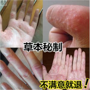 蛇脂肤康王益草本肤康私处毒癣痒净灵朴牛黄膏童百舒宁软膏1人付款68