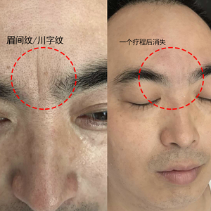 川字纹眉间纹贴去除神器皱纹凹陷填充法令纹鱼尾纹小熨斗日本医朵