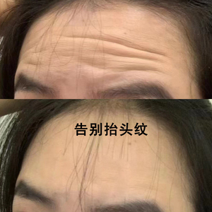 eto医朵抬头纹额头皱纹贴 淡化去除神器川字纹眉间纹男女紧致面膜