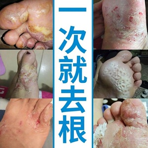 脚气克星药膏