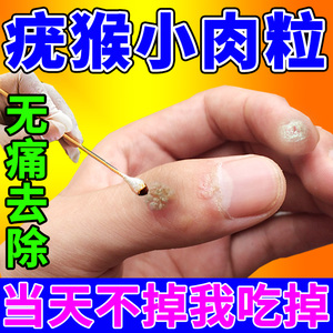 疣瘊肉粒一抹无忧跖疣刺猴肉疣根去除甲周扁平专用膏药点丝状神器