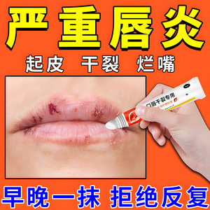 唇膏口角炎唇炎专用药膏口周皮炎女修复嘴唇干裂脱皮烂嘴日本软膏