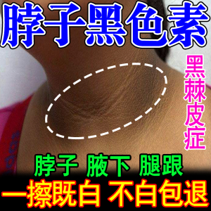 黑棘皮症关节膝盖手肘去黑屁股去黑坐印去除黑色脖子黑黑的变美白