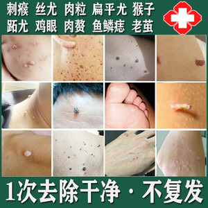 去肉刺瘊子猴子肉粒疙瘩鱼鳞痣药颈部丝疣立净老茧跖疣专用膏去根