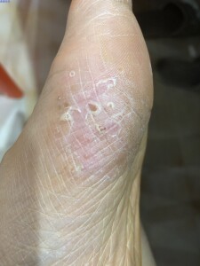 手气脚痒脚气云南百草宁药膏湿疹止痒去根专用治療牛皮癣藓手足癣