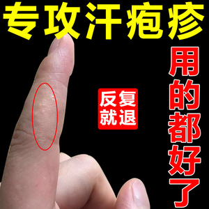 汗孢疹汗状疱疹专用软膏手上起小水泡手痒脱皮干裂手部孢疹药神器