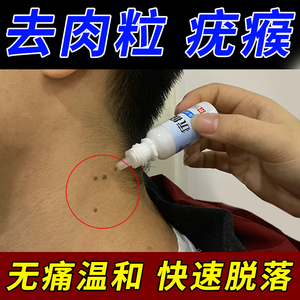 祛肉瘤皮赘去除膏去猴子脖子上长的小肉粒痣疙瘩凸痣肉刺丝状疣药
