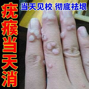治瘊子药祛刺猴去脖子肉粒疙瘩手足部长鱼鳞痣跖疣脚肉刺去除药膏