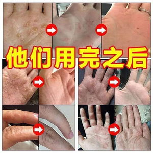 顽固手癣膏真菌感染