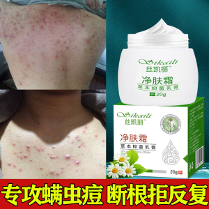 去痘痘药膏