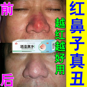 酒槽鼻专用药修复红鼻子治红鼻头鼻翼两侧泛红起皮去草莓鼻凝胶