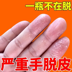儿童手指脱皮
