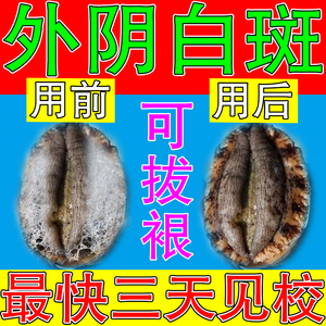治疗外阴白斑药膏萎缩营养不良女私处私密部位皮肤外阴瘙痒止痒膏