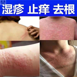 治皮肤痒的药止痒