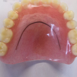 托z塑订齿假托私牙假胶i义牙钢托排制人牙钢牙