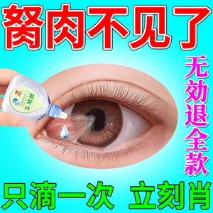 【专肖胬肉】眼角胬肉眼药水去眼睛胬肉翼状胬肉眼睛有异物感z