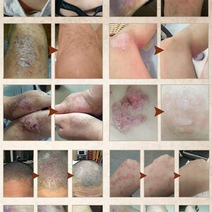 皮毒百治通牛皮癣专用药膏银屑病顽固皮炎k湿疹止痒去根头手足藓