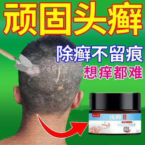 专治头癣药膏