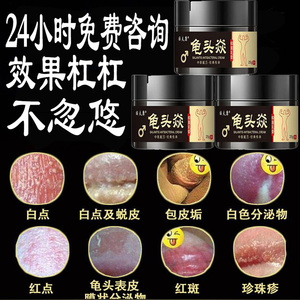 包皮龟头炎霉菌性珍珠疹念珠菌阴茎瘙痒消炎治疗男性喷剂专用药膏