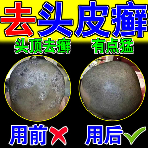 0023人付款淘宝头皮癣药膏治疗头部牛皮大块头皮屑去银屑癣真菌感染