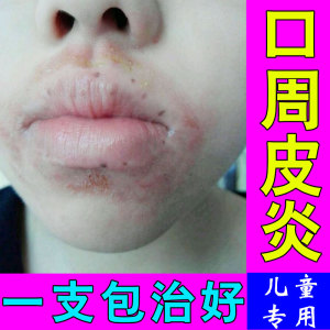 儿童唇炎护唇膏唇周炎舌舔皮炎口周炎无激素修复医用口角烂起皮痒