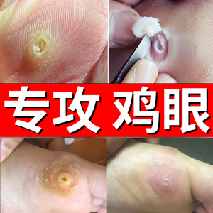 鸡眼脚趾老茧肉刺鸡茧膏眼贴跖疣脚底上专用根神器去除鸡眼药尤茧