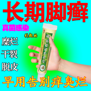 脚癣一次净足癣