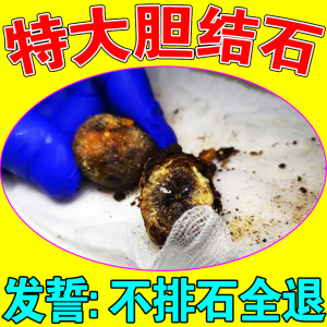 胆结石溶石化石【当晚碎石】肾结石克星金钱草专用排石中草药膏