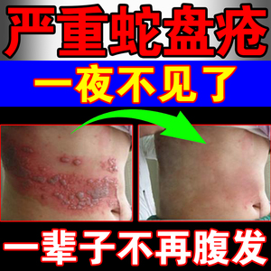 蛇盘疮断根克星蛇缠腰带状疱疹后遗症神经痛外用药膏疱疹拔病毒膏