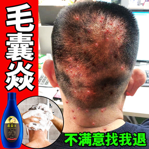 治毛囊炎专用药头上长红疙瘩头皮长痘痘去头皮癣头皮屑止痒洗发水