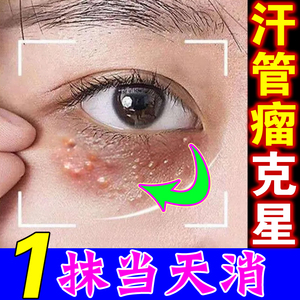 治疗汗管瘤专用药膏去除扁平疣眼周脂肪粒脸黄疣褐色丘疹眼霜神器