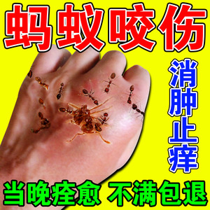 蚂蚁咬伤药膏被红火蚁隐翅皮炎毒臭虫跳蚤蚊子叮用什么消红肿止痒