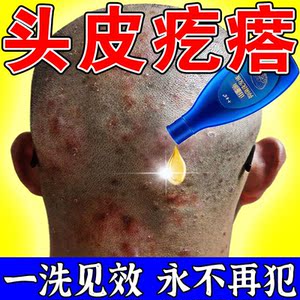 头皮毛囊炎洗剂
