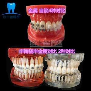 牙科正畸模型自锁金属托槽陶瓷托槽4对比牙模教学讲解医患沟通