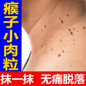 瘊子去除神器去疣灵肉刺去小肉粒疙瘩脖子长刺瘊专用跖疣膏冷敷